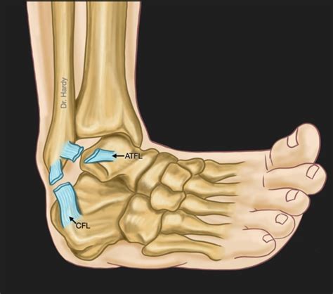 anterior talofibular ligament tear test|anterior talofibular ligament attenuated.